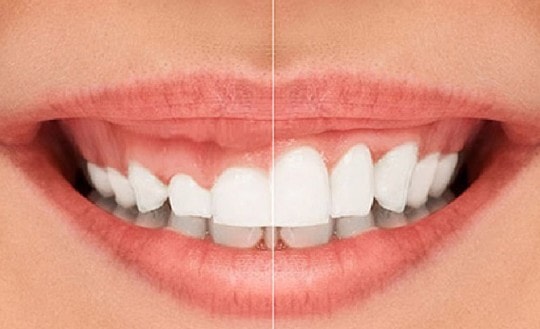 الفرق بين زراعة الاسنان الفورية والتقليدية